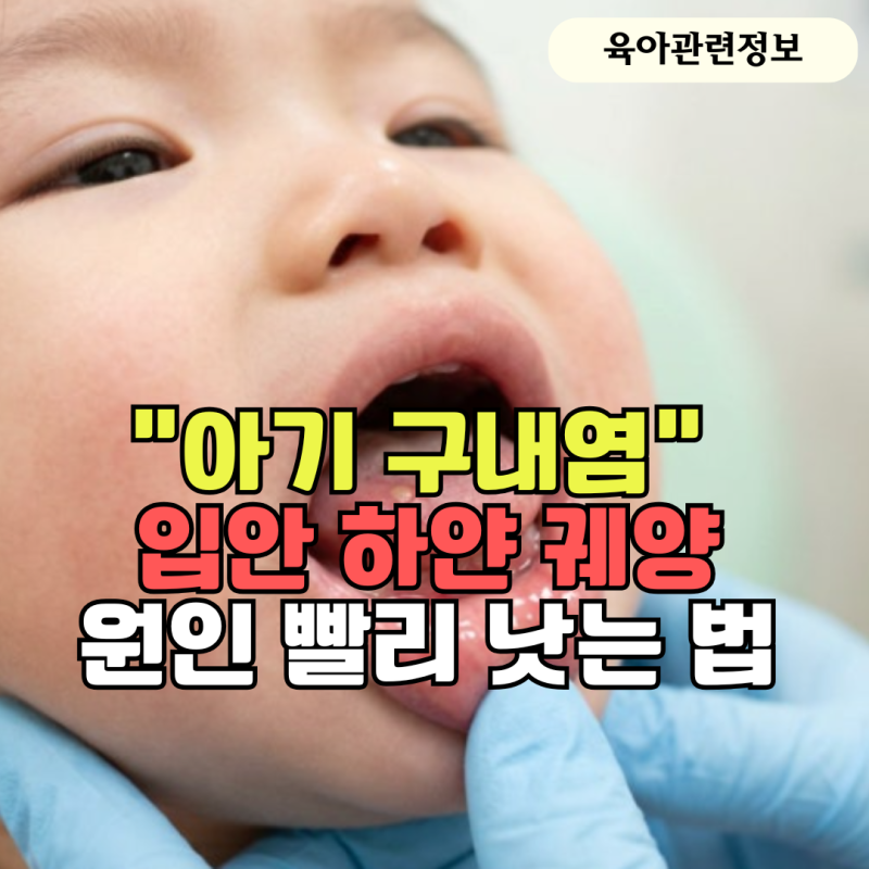 '아기 구내염' 입안 하얀 궤양 원인과 빨리 낫는 법 정리