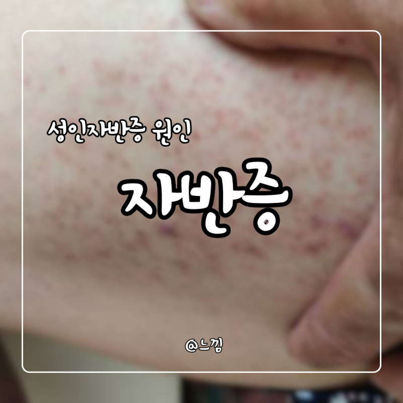 자반증 증상 원인 성인 소아 자반증 치료