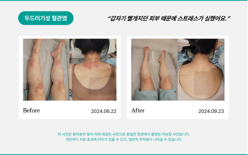 여름마다 모기 물린것처럼 두드러기, 진짜 벌레 때문일까요