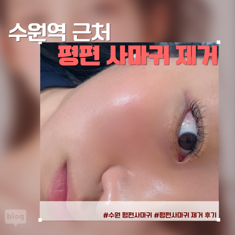 수원 편평사마귀 제거 한의원에서 꼼꼼하게 없앤 후기 (무제한)