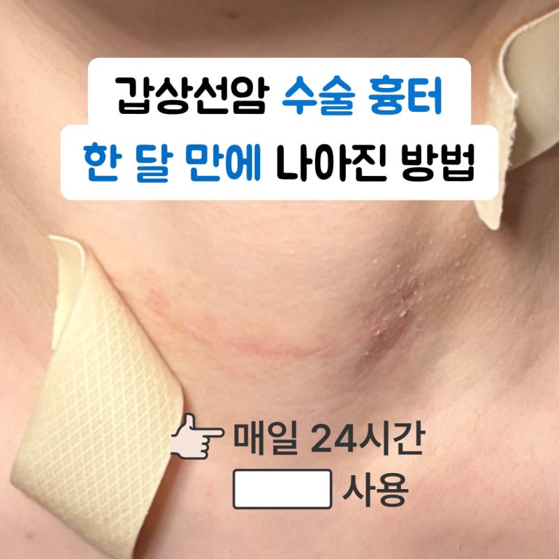 갑상선암 수술 흉터, 목 절개 자국 관리 시기와 연고 사용법