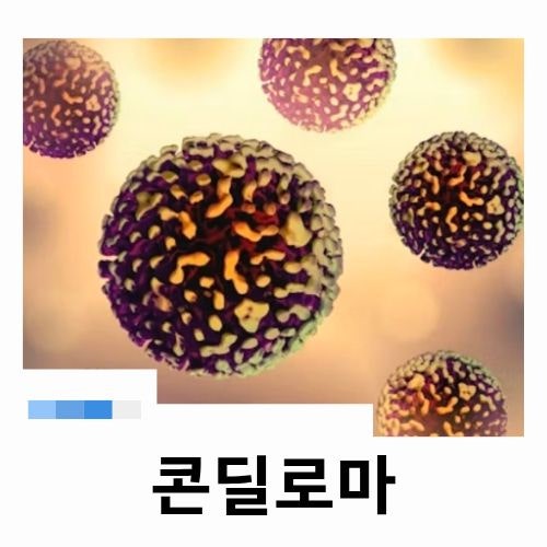 콘딜로마 증상부터 치료까지, 남녀 모두 알아야 할 HPV 감염