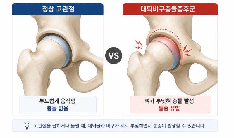 고관절 앞쪽이 찝히고 아파요: 대퇴비구충돌증후군