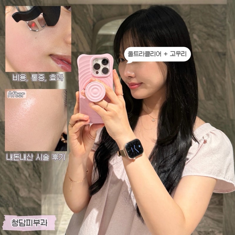 청담피부과 추천 울트라클리어+고우리 패키지 시술 1주차 효과, 가격