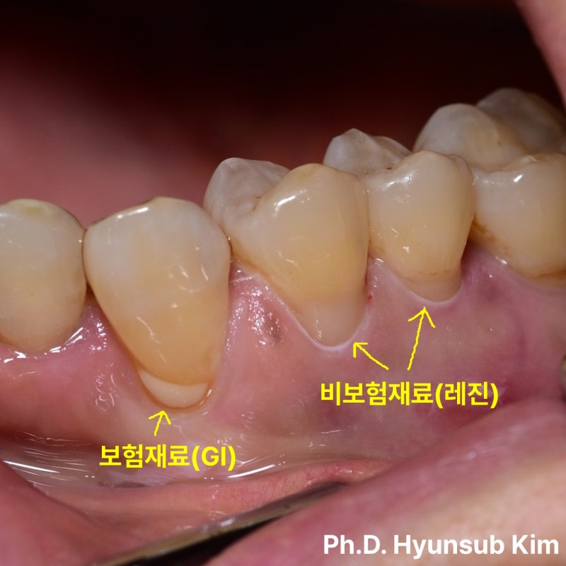 발산역 잇몸 뿌리 패임, 보험 재료와 비보험 재료에 대해 설명드립니다.