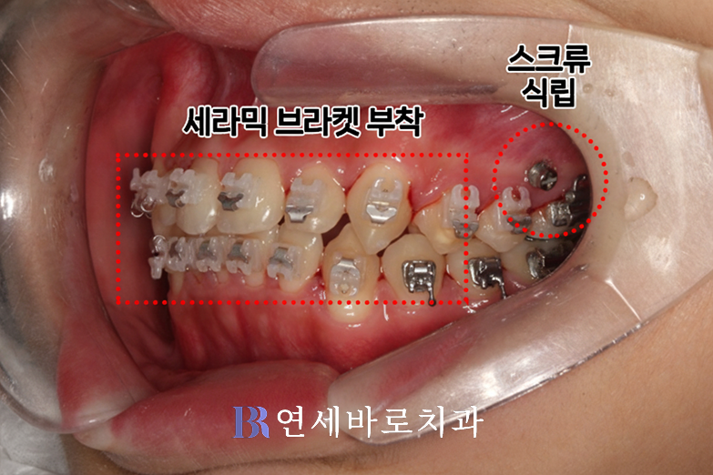 대전 둔산동 치과, 치아교정만 10년 넘게 진료한 이유