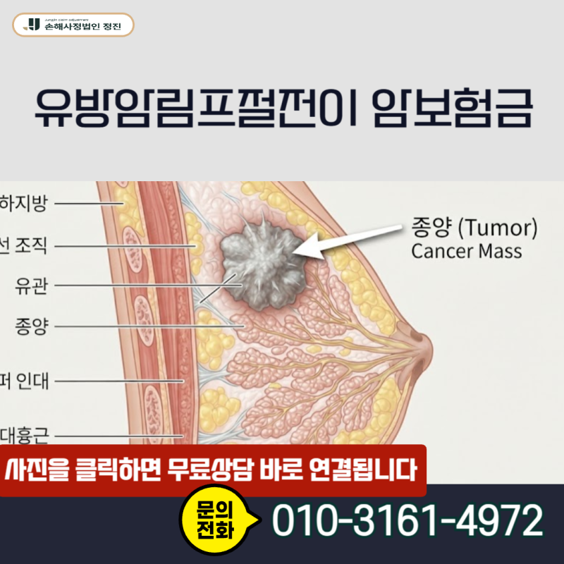 유방암림프절전이 암보험금, C50과 C77 코드가 함께 나왔을 때 일반암 전액 수령이 정말 불가....