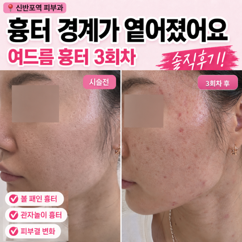 여드름패인흉터치료 성지 곰보피부 셀라스 아인셀 레이저 가격 후기