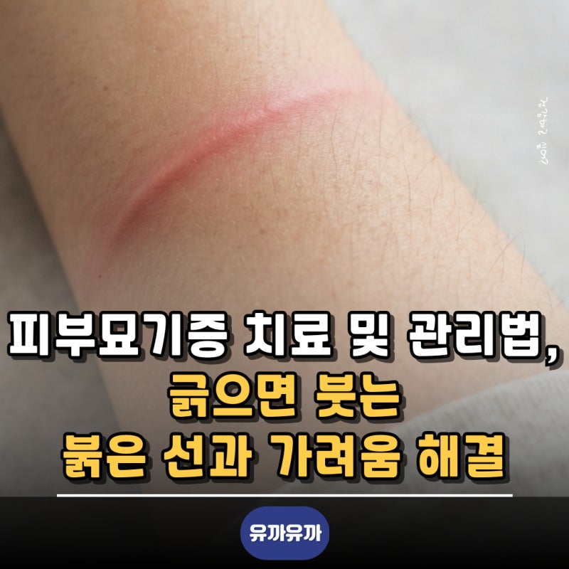 피부묘기증 치료 및 관리법, 긁으면 붓는 붉은 선과 가려움 해결