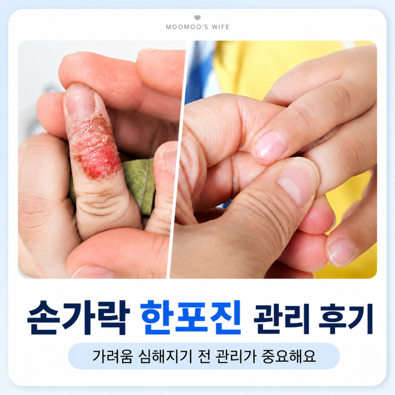 손가락 한포진 증상 치료, 손바닥 수포 물집 가려움 후기