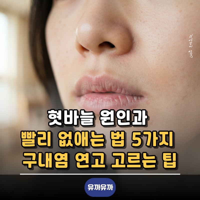 혓바늘 원인과 빨리 없애는 법 5가지 구내염 연고 고르는 팁