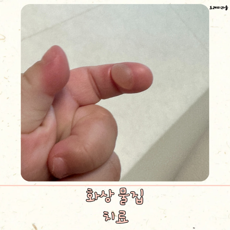아기 화상 물집 치료 병원 손가락 응급처치