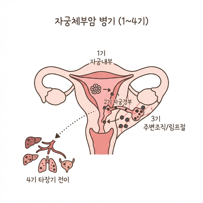 자궁체부암 병기 총정리｜1기부터 4기까지 진행 단계와 예후 차이