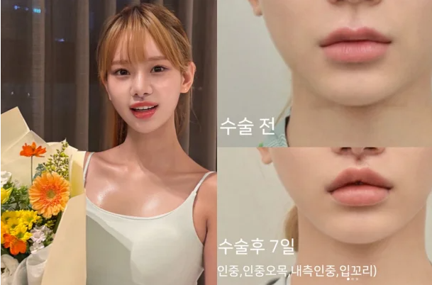 맹승지 인중축소·입꼬리 수술 전후 비교…“짧아진 인중, 더 어려 보여”