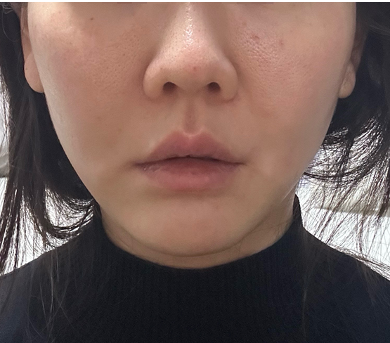 [내돈내산] 편평사마귀, 비립종, 점 제거 후기(C02레이저+피코토닝)
