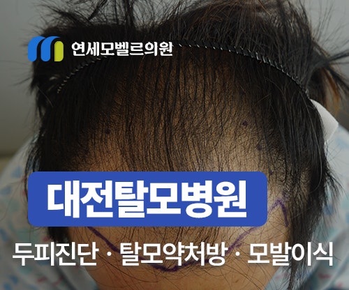 대전탈모병원 두피 정밀 진단부터 탈모약 처방, 모발이식 상담까지