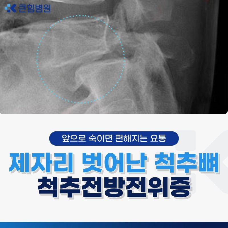 부산 척추전방전위증 치료, 수술 전 알아야 할 것들