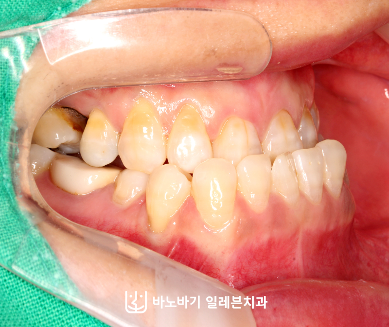 주걱턱 성인 3급 부정교합 유형과 종류 및 비수술 치아교정 방식 정리