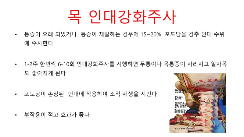 후두신경통의 치료 신경차단술과 인대강화주사