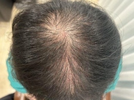 쏘팔메토 옥타코사놀 효능 모르고 먹으면 간 망가집니다 (주의)