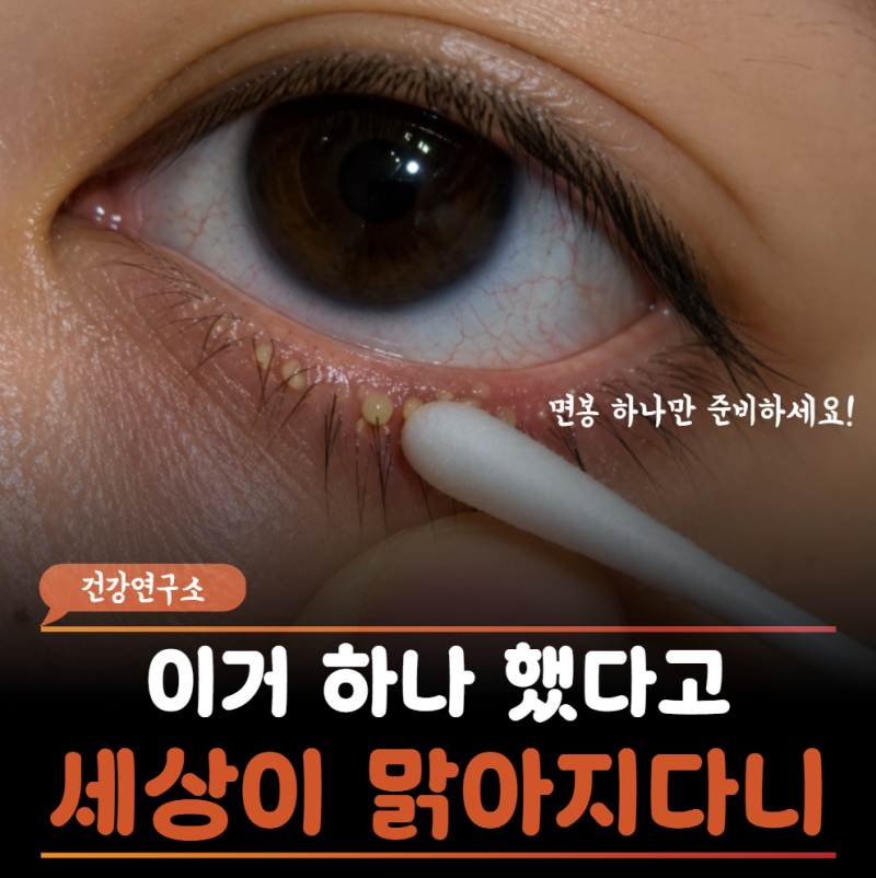 "인공눈물 아무리 넣어도 뻑뻑하다면?" 눈꺼풀 기름때 5분 만에 시원하게 짜내는 마이봄샘 청....