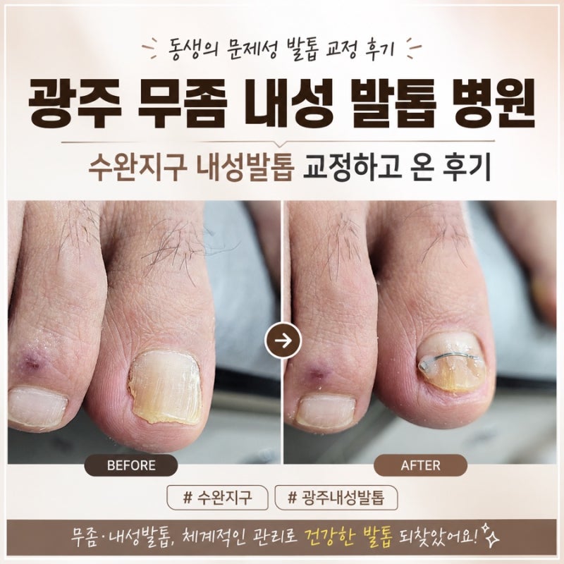 광주 무좀 내성 발톱 병원 동생 데리고 수완지구 문제성 발톱 교정하고 온 후기