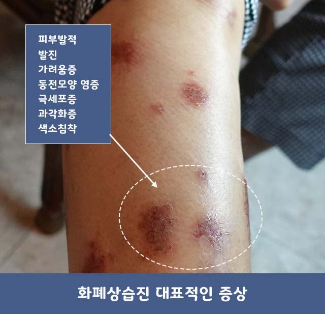 화폐상습진 - 증상을 이해할 때 원인을 알 수 있다!!