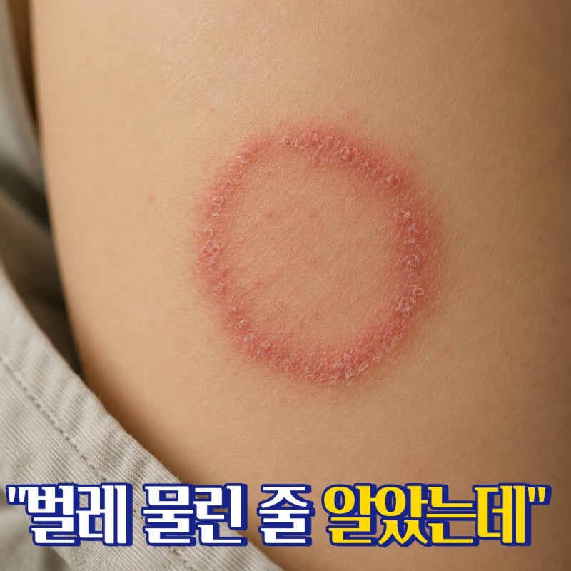 체부백선 원인 가려운 원형 발진이 점점 번졌다면