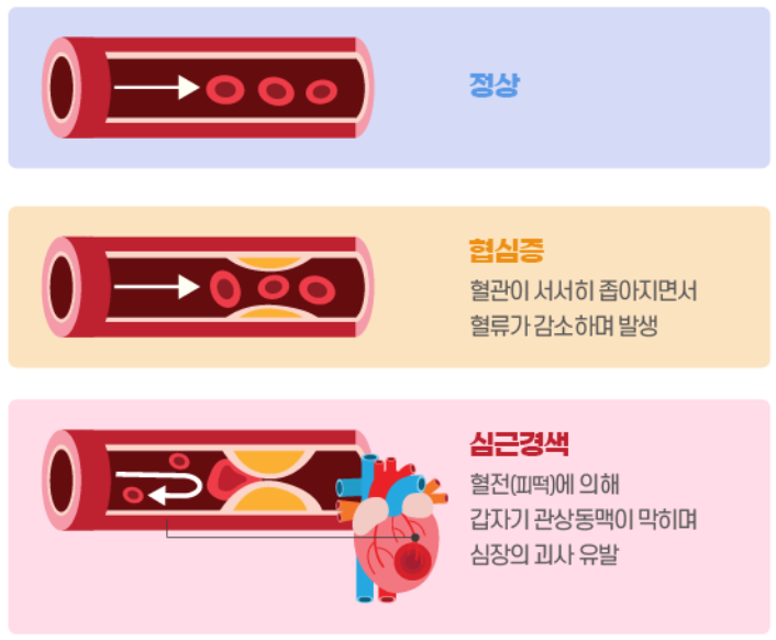 협심증과 심근 경색 그리고 부정맥 증상 원인은? 심장질환 증상 및 종류