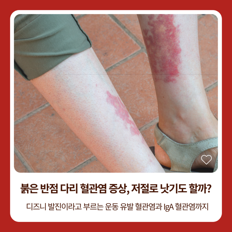 다리 혈관염, 혈관염 증상과 원인부터 IgA 혈관염까지 | 은평구 혈관외과