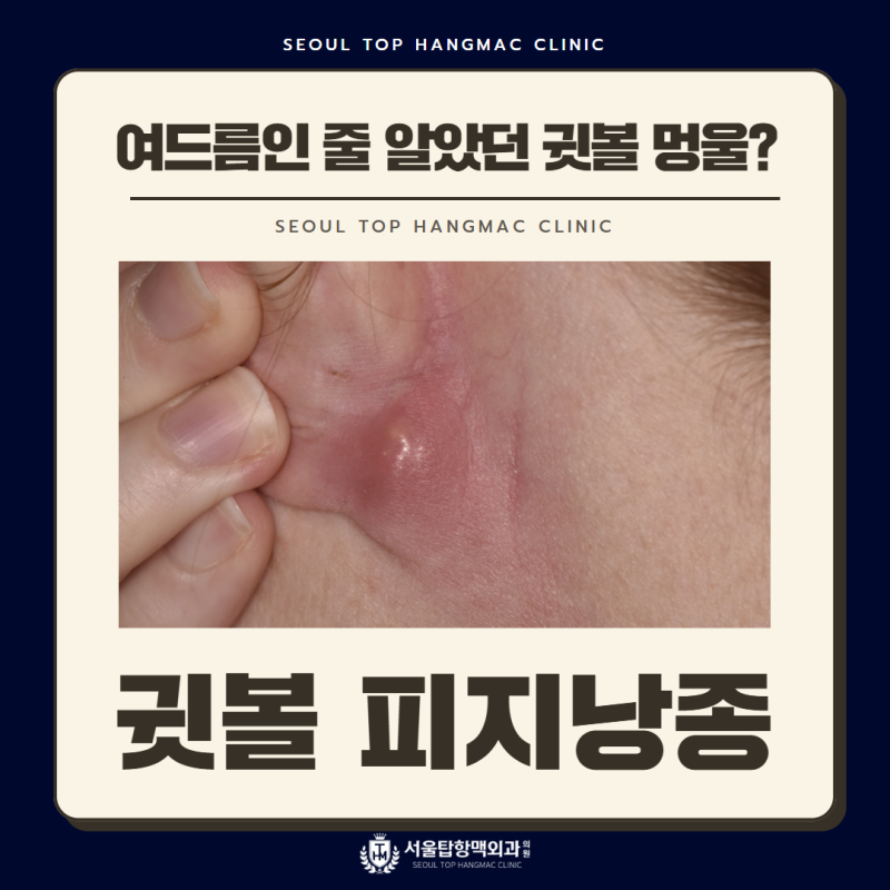 여드름인 줄 알았던 귓볼 멍울, 피지낭종일 수 있습니다.