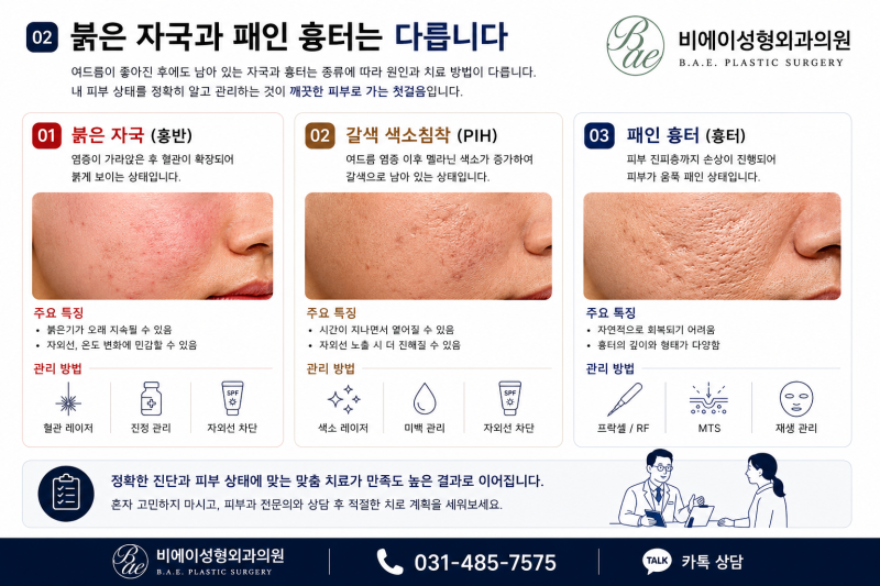 안산여드름흉터, 여드름이 끝난 후 더 중요한 치료는?