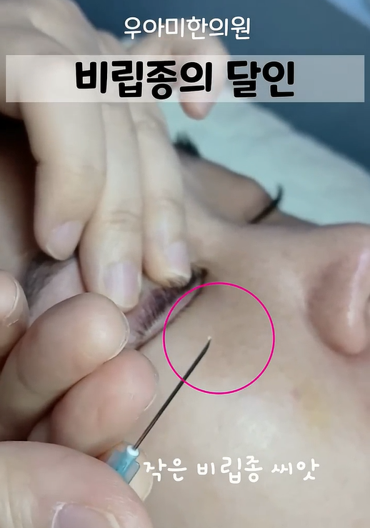 눈 비립종 압출, 눈가•눈밑•눈꺼풀 제거 방법과 피부과 비용