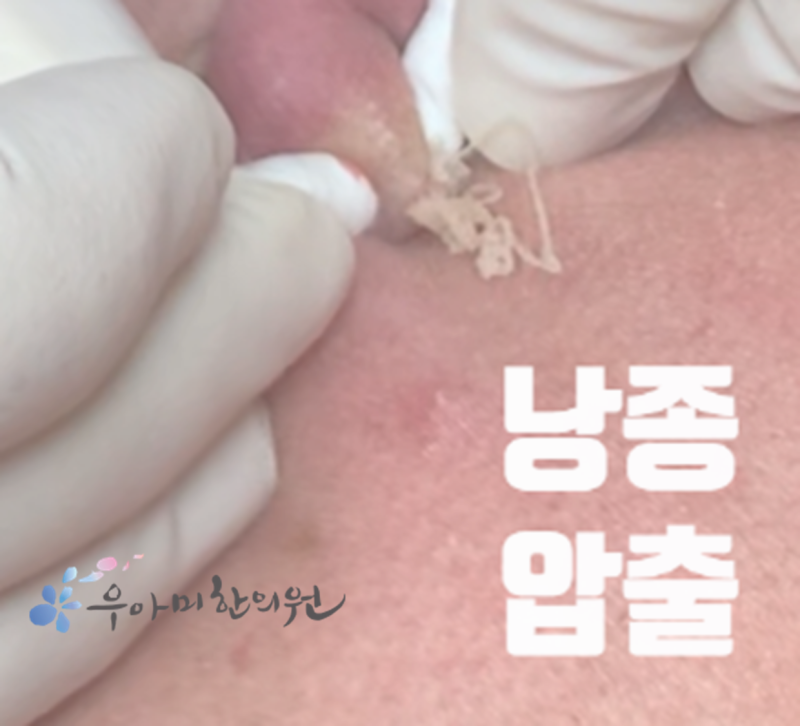 생식기 뾰루지, 사마귀와 피지낭종은 어떻게 구분할까요?