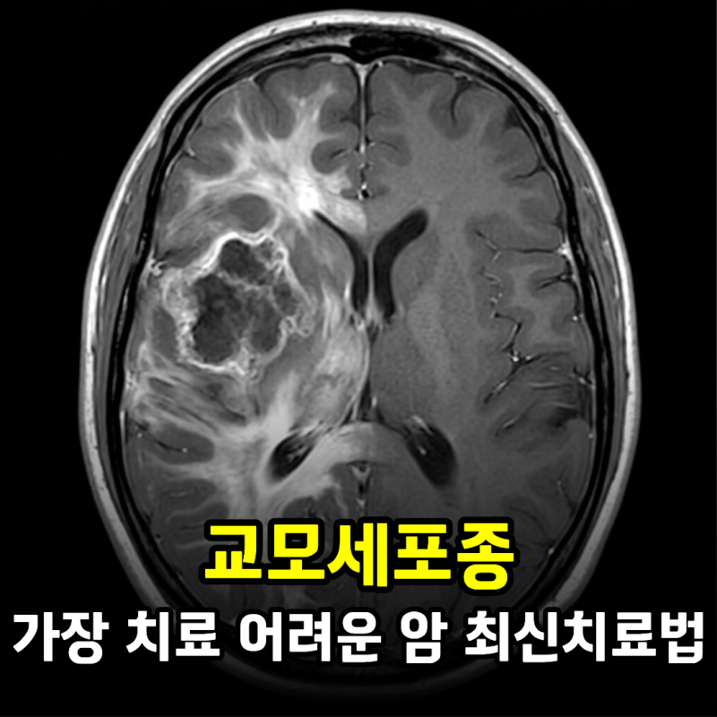 가장 치료가 어려운 암 최신치료법, 교모세포종에 희망이 생겼을까?