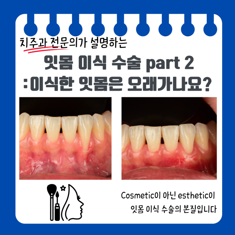 앞니 잇몸 퇴축 치료 - 잇몸 이식 수술은 '미용(Cosmetic)'이 아니라 '생물학적 심미(Esthetic)'의 ....