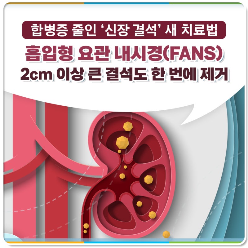 합병증 줄인 ‘신장 결석’ 새 치료법흡입형 요관 내시경(FANS)2cm 이상 큰 결석도 한 번에 제....