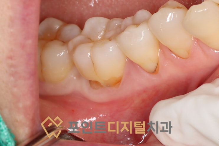 [탕정치과] 잇몸 경계 부위 떼운 게 또 떨어졌다면? 오래 유지되는 치 경부 마모증 레진 치료 / 천안 아산