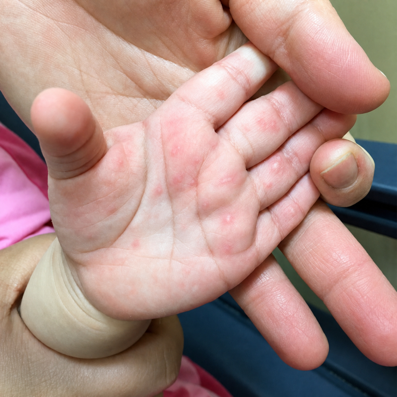 수족구 초기증상, 밥 안 먹고 짜증 내는 아이 - 수포, 열, 식단, 어린이집 총정리