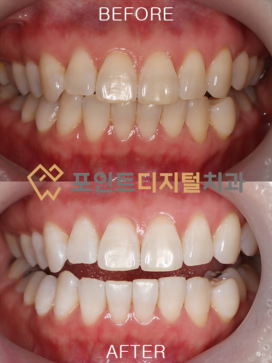 [탕정치과] 40대 치아미백, 정말 효과 있을까? (A3.5에서 B1으로! 대표원장이 직접 진행하는 치아미백) / 천안 아산