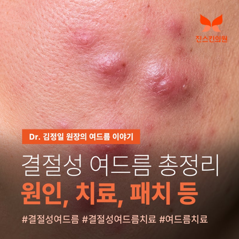 결절성 여드름 원인부터 압출·치료·패치·주사·연고까지 총정리