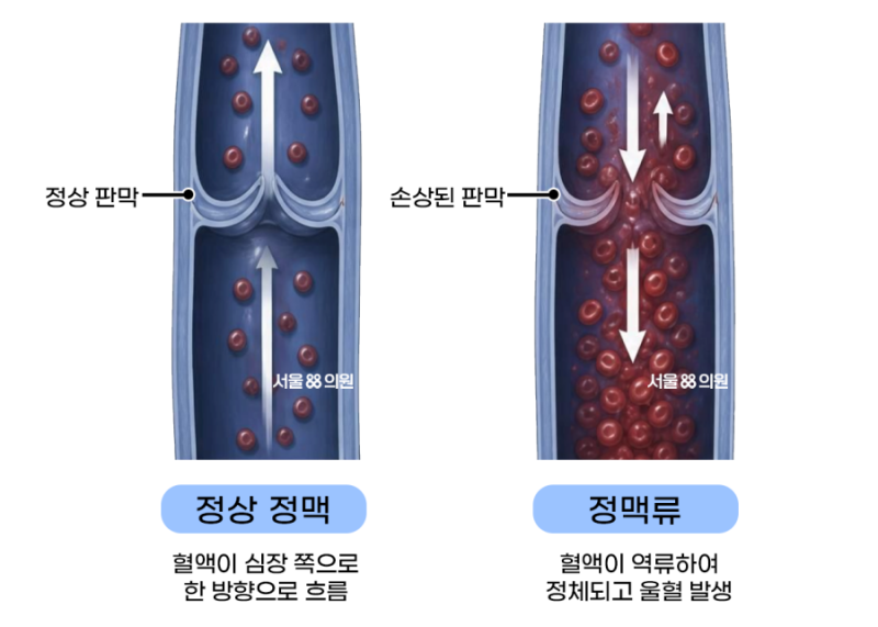 골반정맥류(골반울혈증후군)! 어디서, 어떻게 치료하나요?