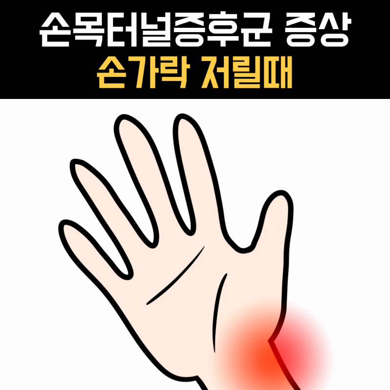 손목터널증후군 증상, 밤마다 엄지·검지·중지가 저린다면?