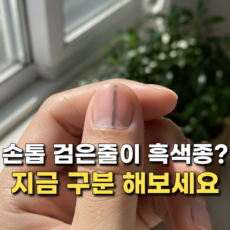 손톱 검은 세로줄 흑색종 신호일까? 구별하는 방법