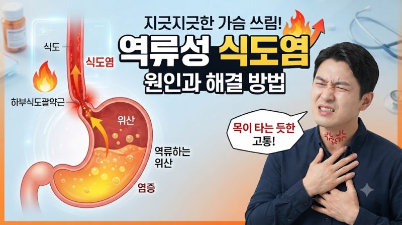 역류성식도염 증상 총정리 ② 목 이물감, 음식 걸림, 기침 원인과 해결방법