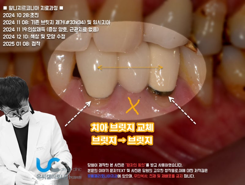치아브릿지 교체 상실치아가 없을 땐 싱글(개별) 앞니 크라운으로