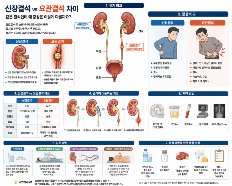신장결석 vs 요관결석 차이