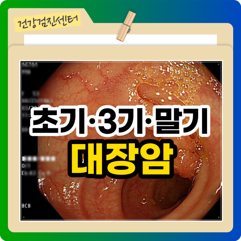 대장 선종이 대장암으로 진행되는 과정(초기, 3기, 말기 사진)