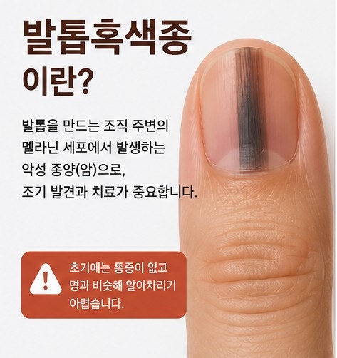 발톱흑색종 증상 총정리｜멍인 줄 알았는데 암일 수도?