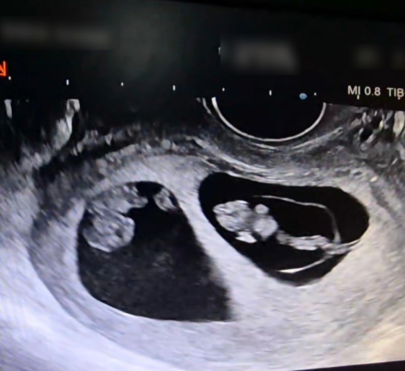 쌍둥이 임신 초기 증상 기록｜6주,7주,8주,9주,10주,11주,12주(입덧시작,토덧,니프티검사)